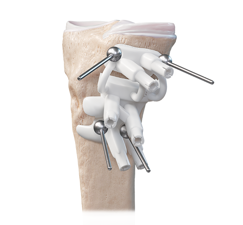 Arthrex - BoneSync Fast-Setting Drillable Calcium Phosphate Cement